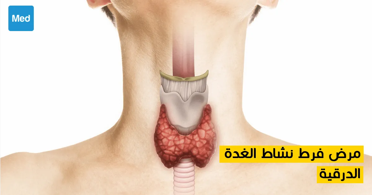 مرض فرط نشاط الغدة الدرقية